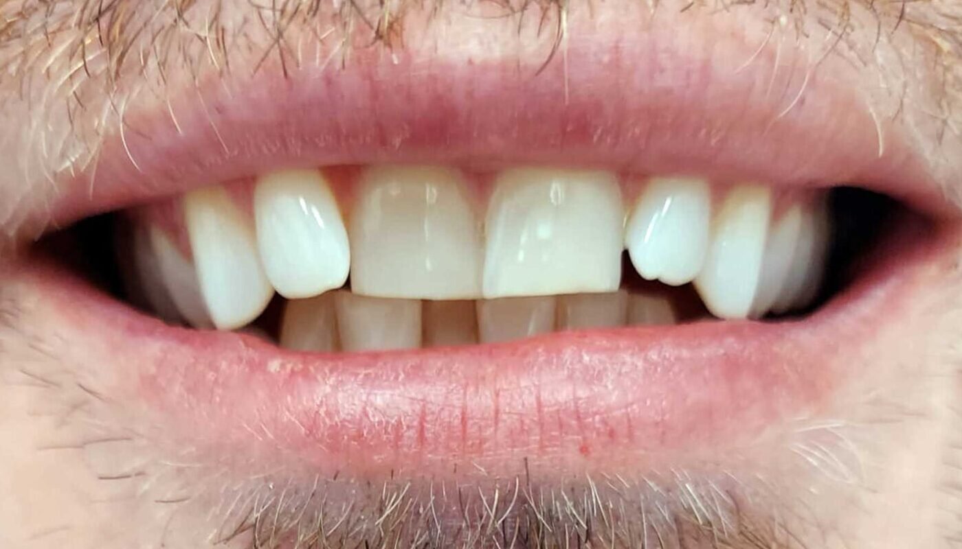 before-after