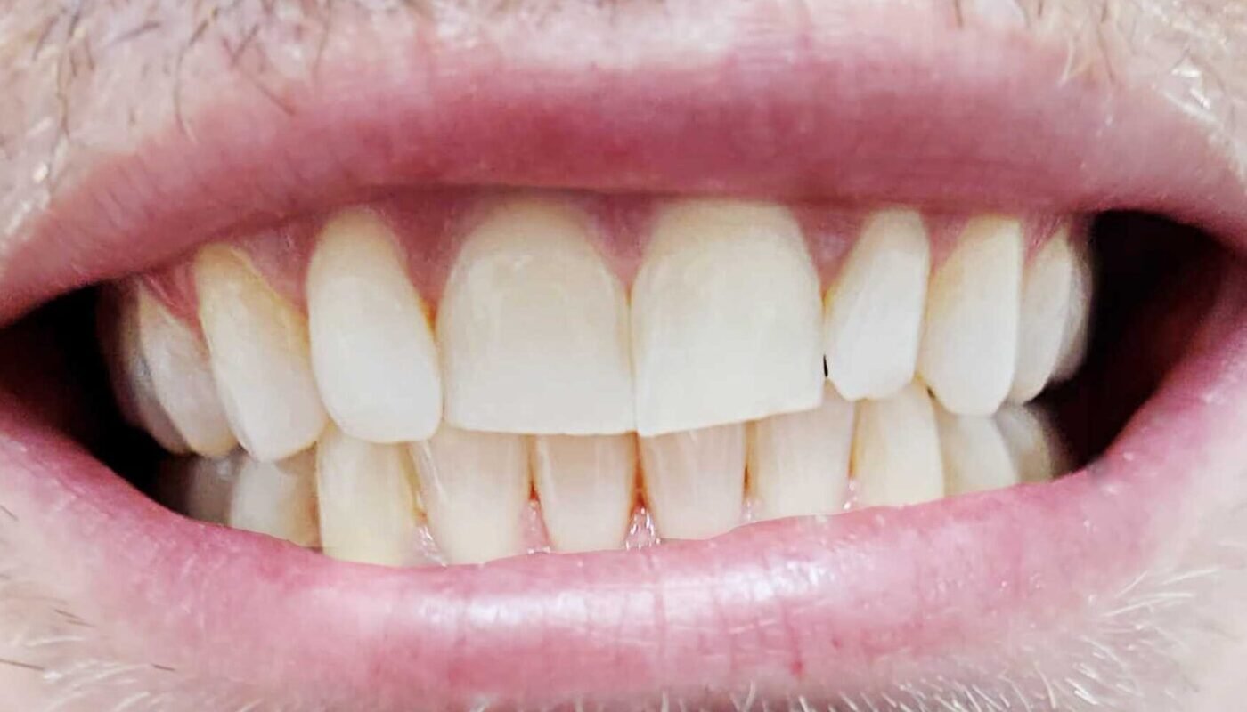 before-after