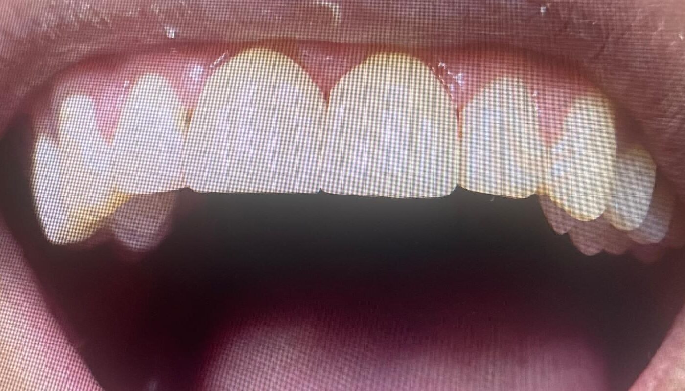 before-after