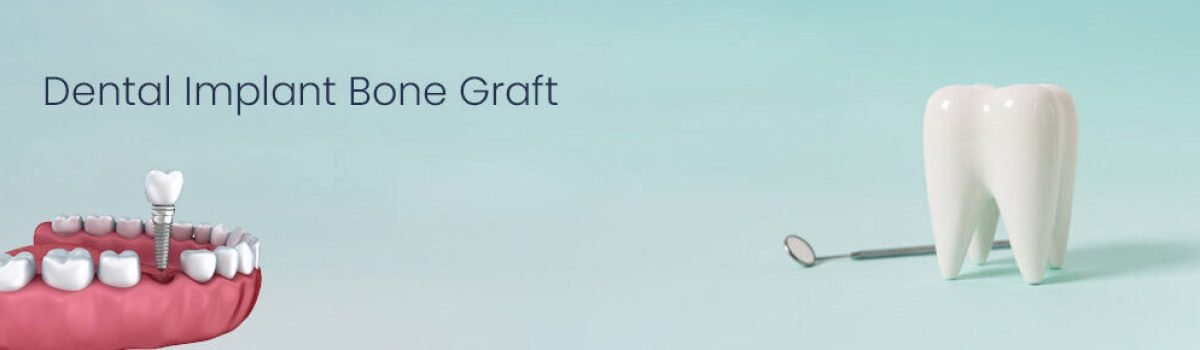 Dental implant Dental implant