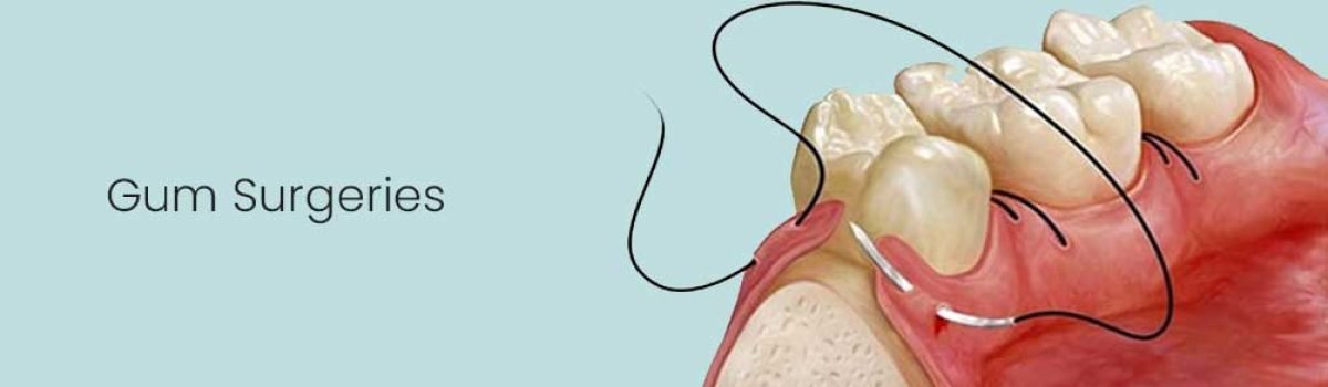 Gum-surgeries Gum-surgeries