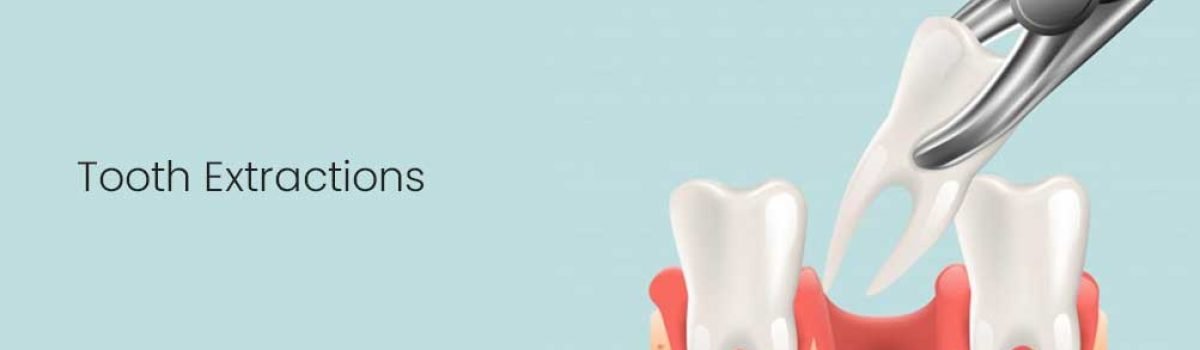 tooth-extraction Royse City